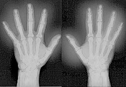 UCD Centre for Arthritis Research